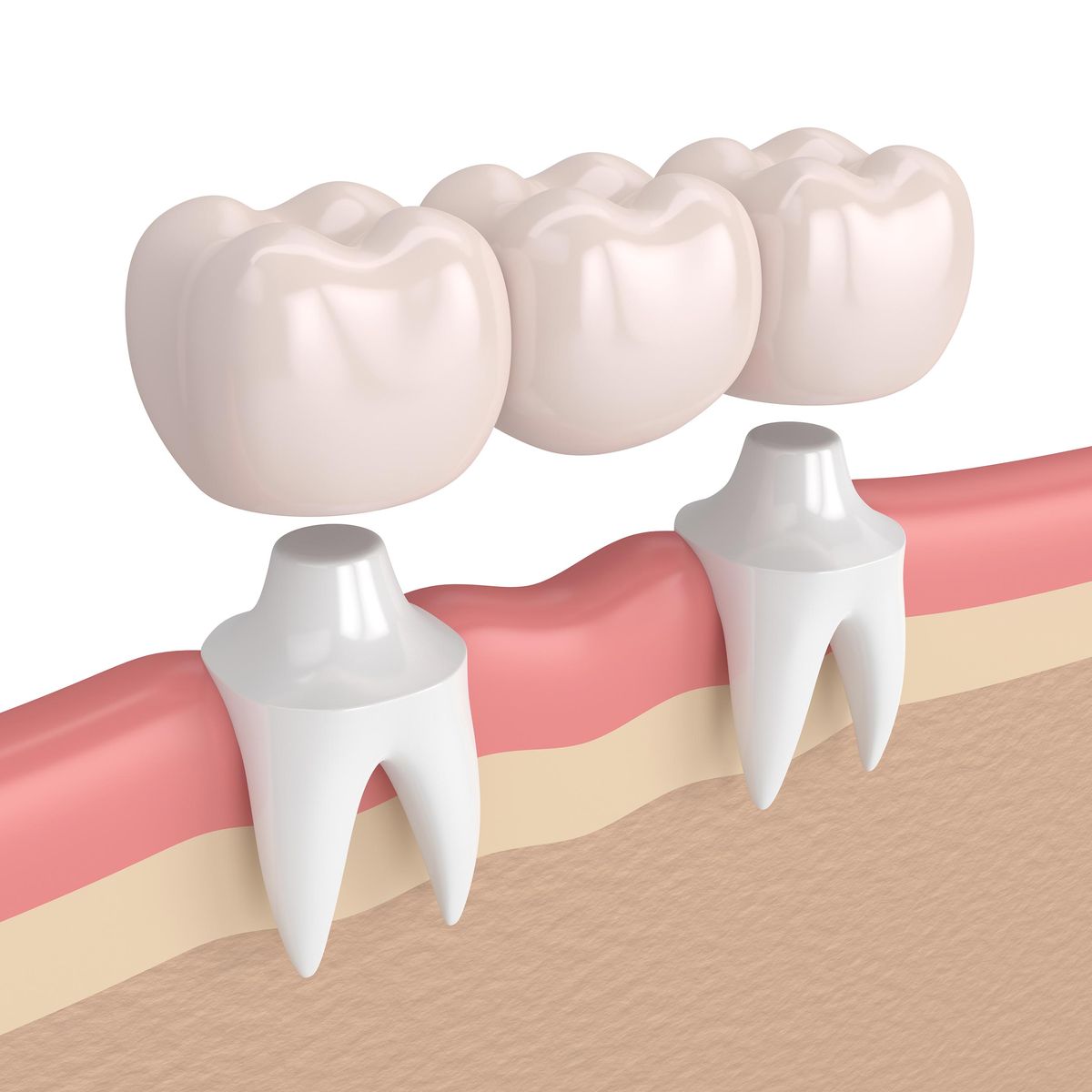 Crowns and Bridges – Dental Restorations